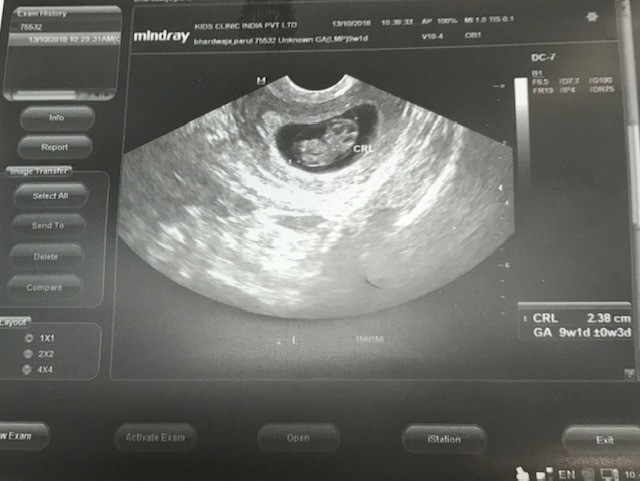 Gestation-sac-with-foetus-inside