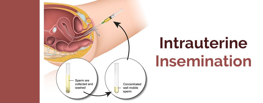 Intrauterine-Insemination
