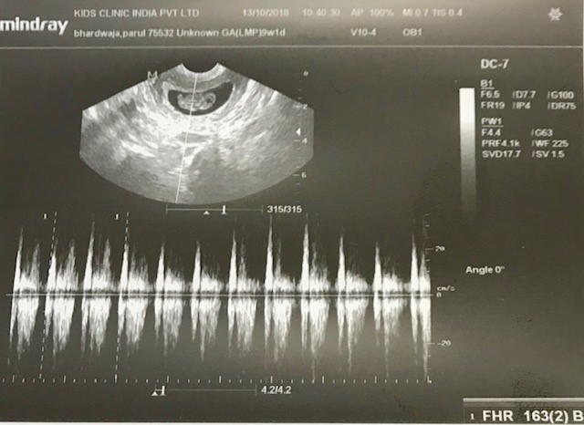 Documented-foetal-heart